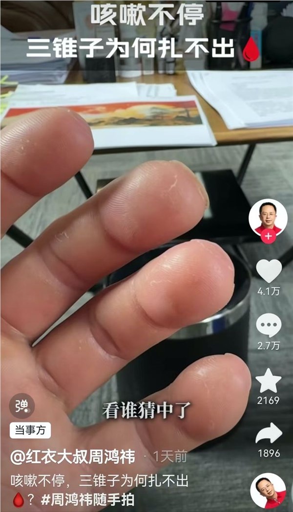 周鸿祎手指三针扎不出血 网友称像杵状指 真相大白