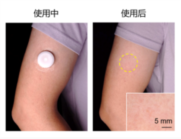 浙大团队发明贴敷式输注贴：实现无痛“无线”挂盐水